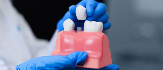 Fed up with gaps in your smile? 5 reasons why oral implants are the answer!